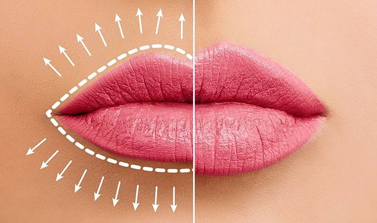 Dudak dolgusu sonrası nelere dikkat edilmeli?