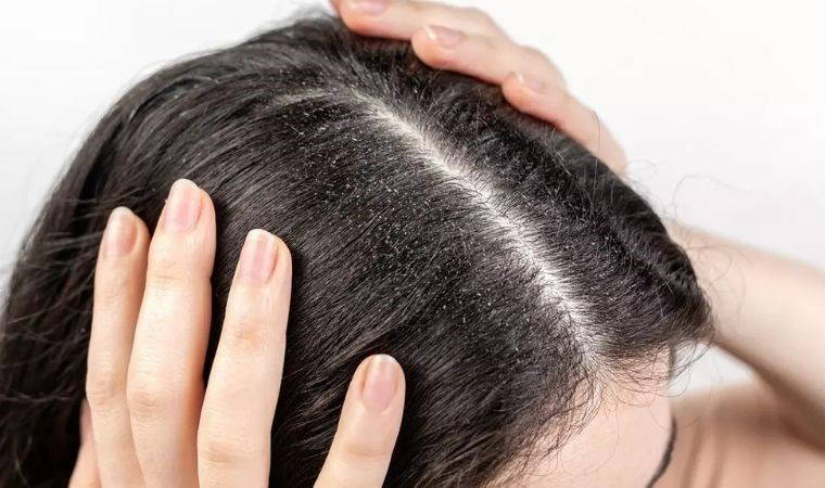Saç derinize ferahlık ve temizlik getirin: Kepek problemine son veren 6 doğal yöntem