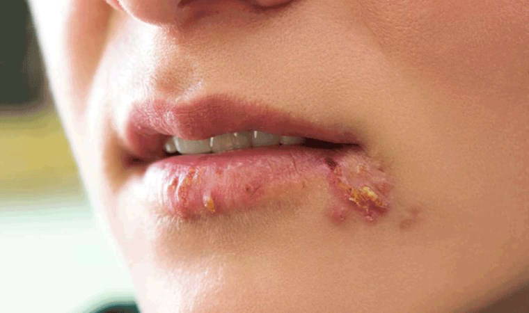 Doğadan gelen şifa ile ağrısız ve hızlı çözümler: Uçuğa iyi gelen 7 etkili doğal yöntem