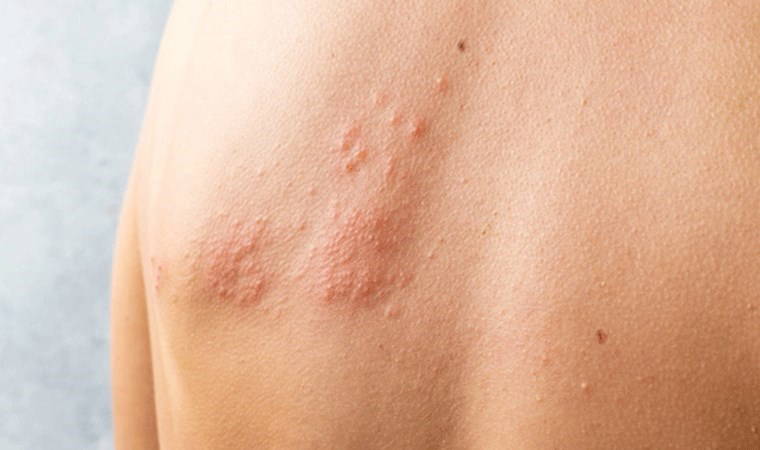 Stres ve yorgunluk zona virüsünü nasıl tetikliyor?