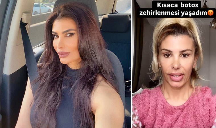 Botokstan zehirlendi! Türkücü Hatice: 'Yanlış botoks mağduru oldum'