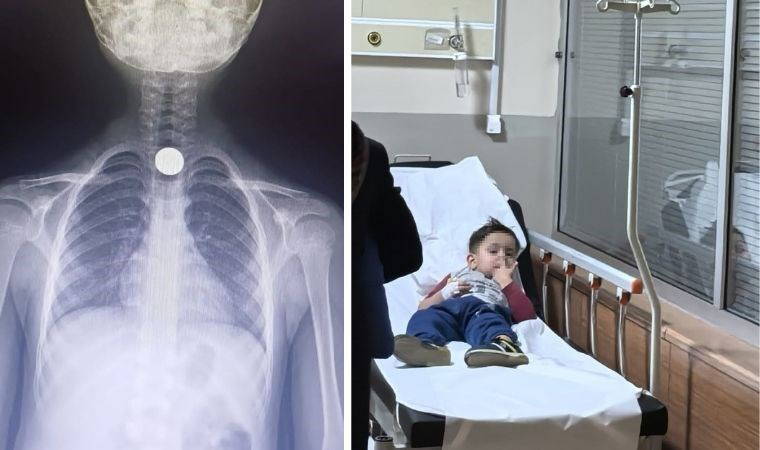 Yusuf'un yemek borusuna takılan madeni para operasyonla çıkartıldı