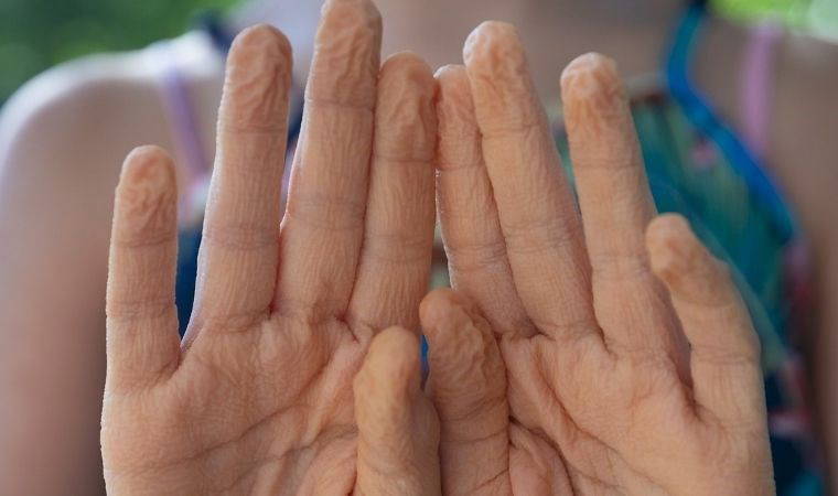 Parmaklar uzun süre suya maruz kalınca neden buruşur?