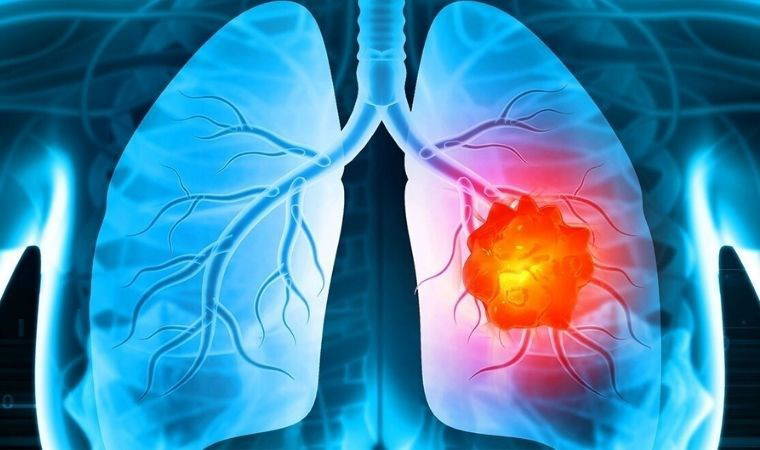 Beslenme alışkanlıklarının başka bir kanserle daha ilişkisi bulundu