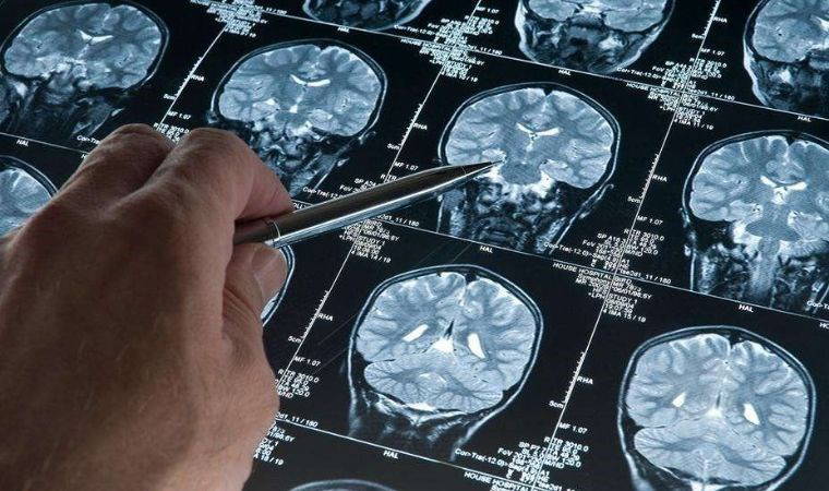 Günlük hayatta karşılaşılan ufak unutkanlıklar alzheimer habercisi olabilir