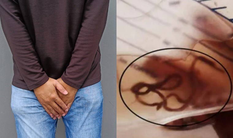 Gaz sancısı sandı, mesanesinden dev parazit çıktı!