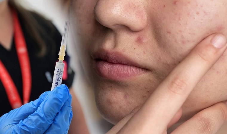 Dünya tarihinde bir ilk: 'Sivilce aşısı' geliştiriliyor