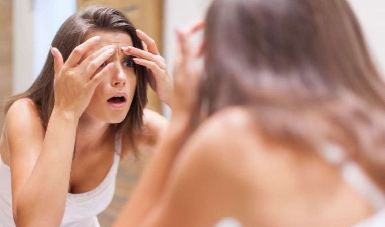 Sivilceleri hızla geçiren 7 doğal çözüm