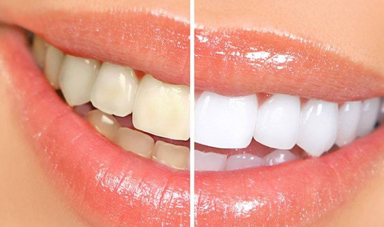 Diş beyazlatmada doğru bilinen yanlışlar