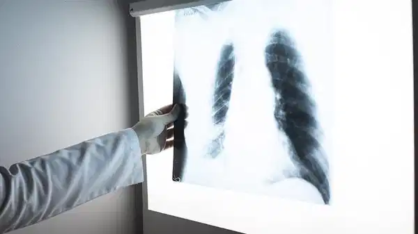 Her yıl milyonlar etkileniyor: Tüberlükoz (verem) tehdidi sürüyor!