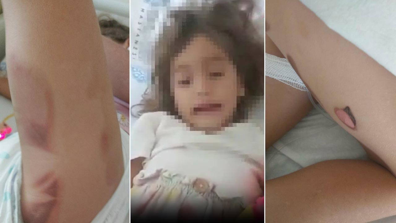 3 yaşındaki Yaren apandisit ameliyatından yanık izleriyle çıktı!