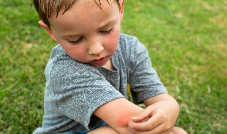 Kaşıntıyı durduruyor, yara ve kızarıklıktan eser bırakmıyor: Sivrisinek ısırıklarına iyi gelen 7 doğal yöntem