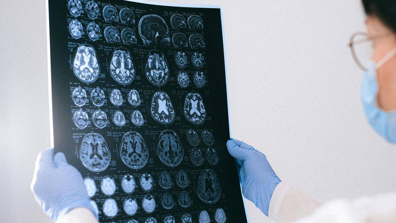 Alzheimer'a virüsler mi yol açıyor?