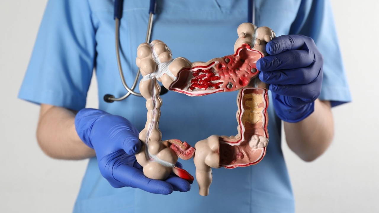 Kolon kanserine karşı altın öneriler: Beslenme hayati rol oynuyor