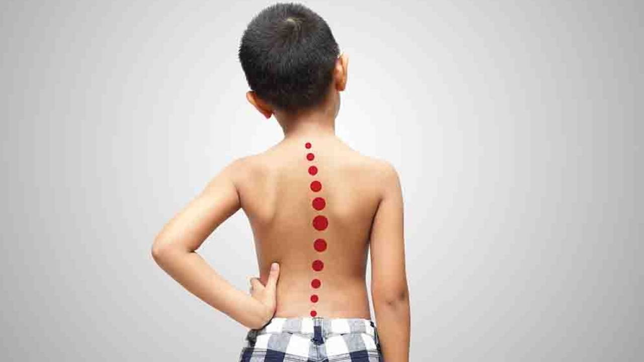 Skolyozda tedaviyi Cobb açısı belirliyor: 'Ergenlikte hızla ilerleyebiliyor'