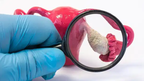 Her 10 kadından birinin gizli sorunu: Endometriozis nedir?