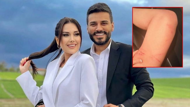 Dilan Polat darp izlerini paylaşıp sildi: 'Boşanacaksın oğlum benden'