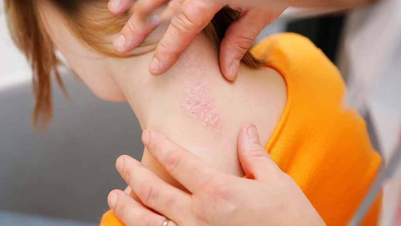 Psöriatik artritte erken tanı önem taşıyor