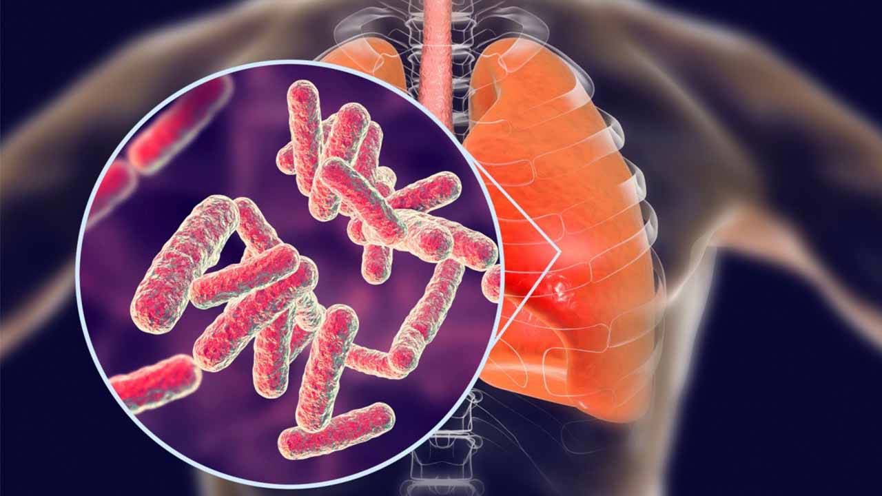 DSÖ: Tüberküloz nedeniyle her yıl bir milyon kişi hayatını kaybediyor