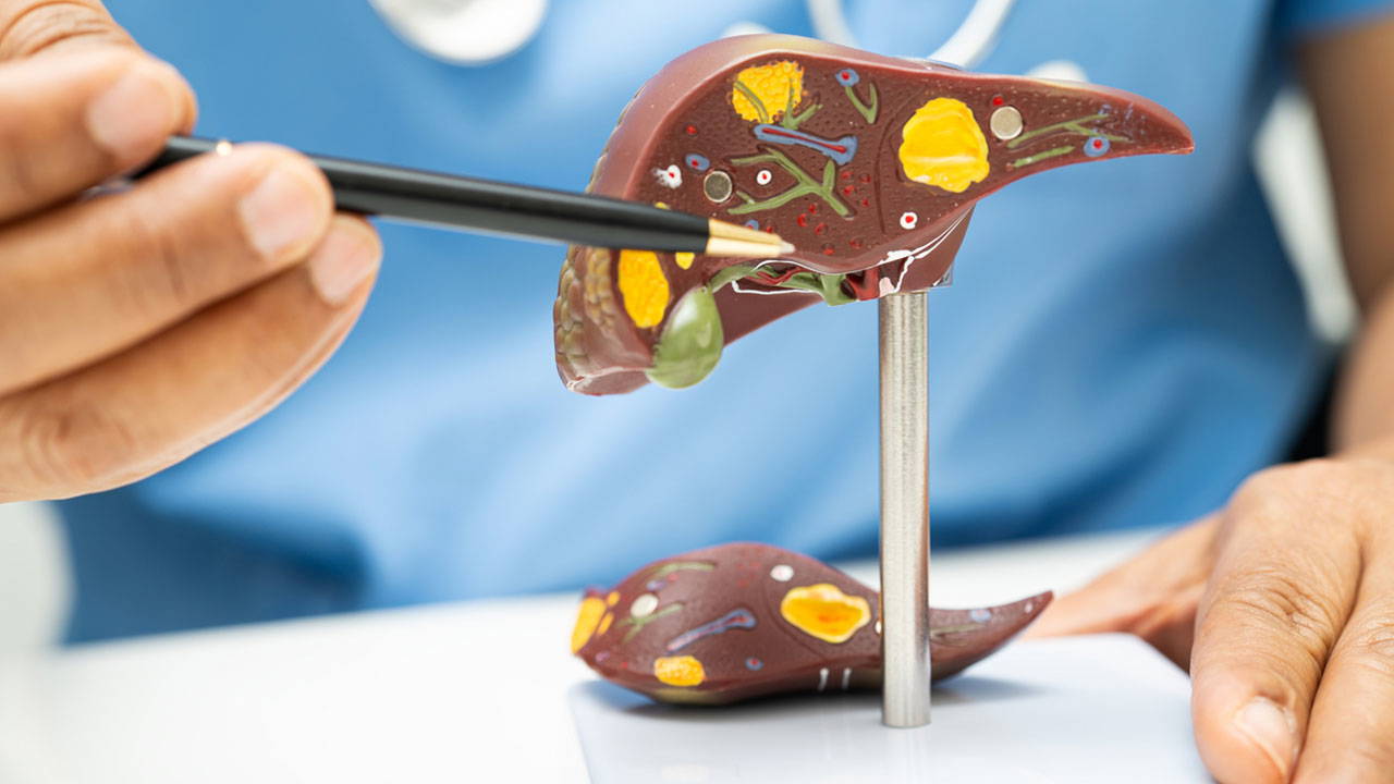 4 kişiden 1'i risk altında: Fark etmeden ilerliyor, siroza dönüşüyor!