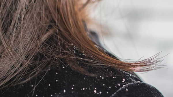 Geçmeyen kepek cilt hastalıklarının sinyali olabilir