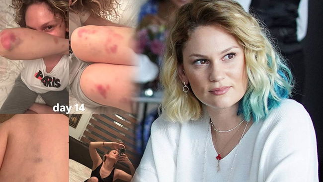 Farah Zeynep Abdullah'ın vücudundaki morluklar endişelendirdi!