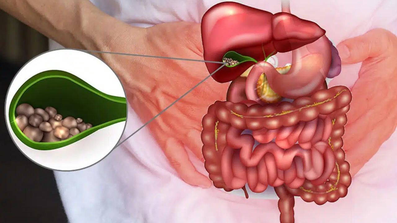 Safra kesesi ameliyatlarının artmasının nedeni zayıflama iğneleri olabilir