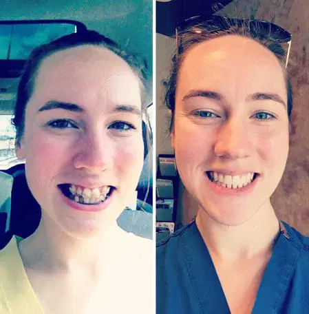 Diş teli taktırdıktan sonra adeta evrim geçirdiler