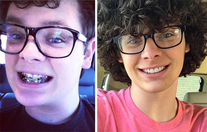 Diş teli taktırdıktan sonra adeta evrim geçirdiler