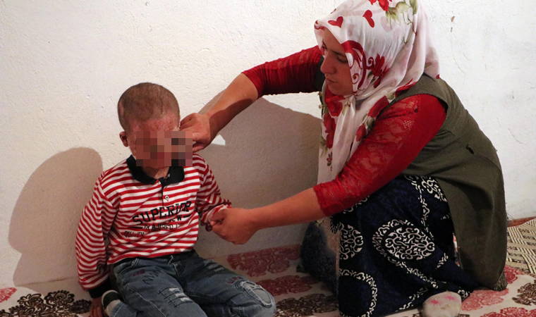 Cilt kanseri henüz 8 yaşında, gün ışığına çıkamıyor...  