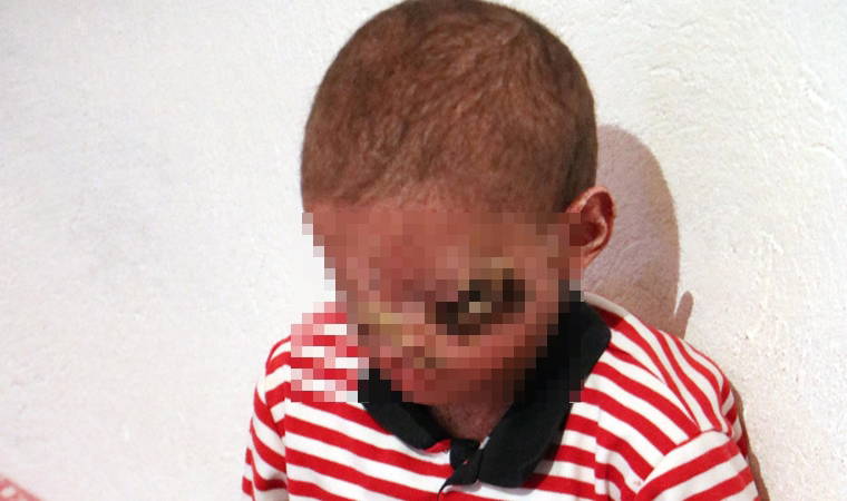 Cilt kanseri henüz 8 yaşında, gün ışığına çıkamıyor...  