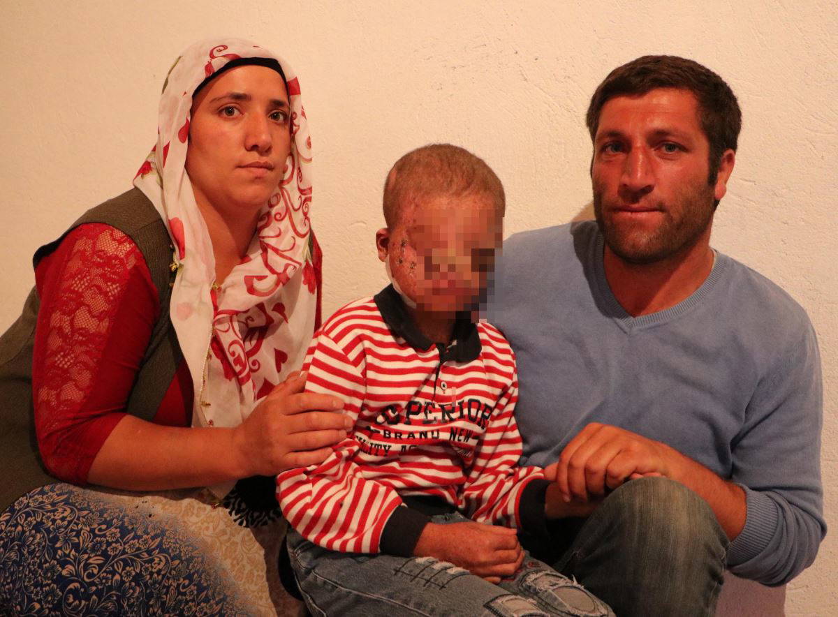 Cilt kanseri henüz 8 yaşında, gün ışığına çıkamıyor...  