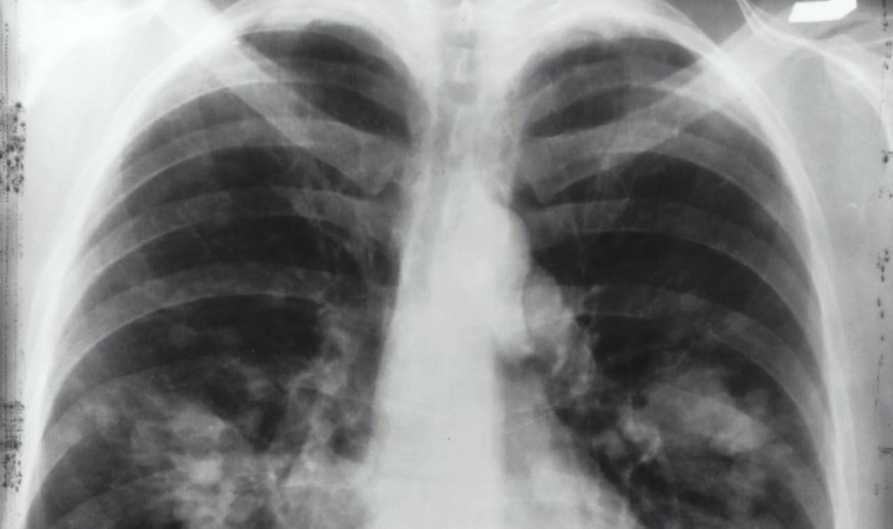 Astım hastalığının asla ihmal edilmemesi gereken belirtileri