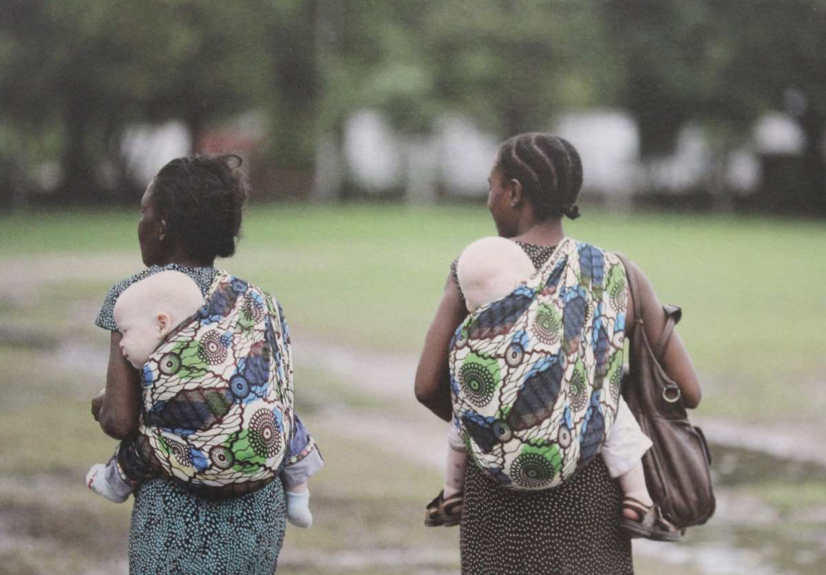 13 Haziran Dünya Albinizm Farkındalık Günü: Albinizm nedir? Albinizmin tedavisi var mı?