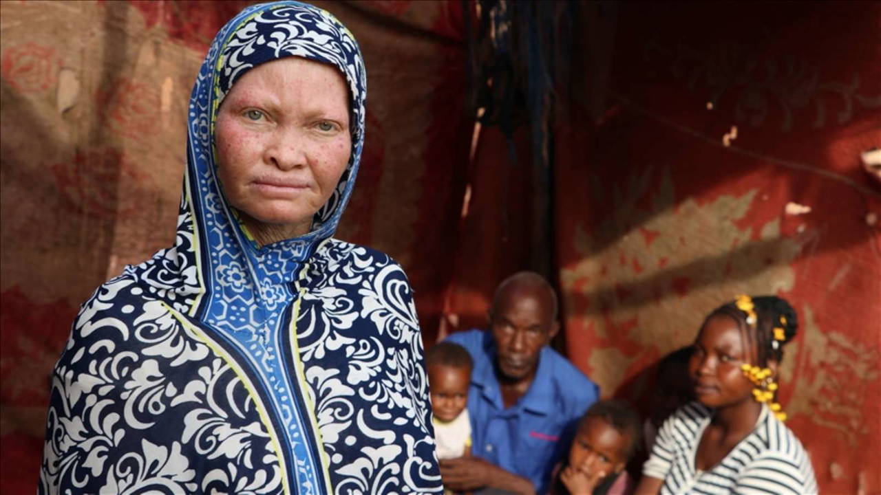 13 Haziran Dünya Albinizm Farkındalık Günü: Albinizm nedir? Albinizmin tedavisi var mı?