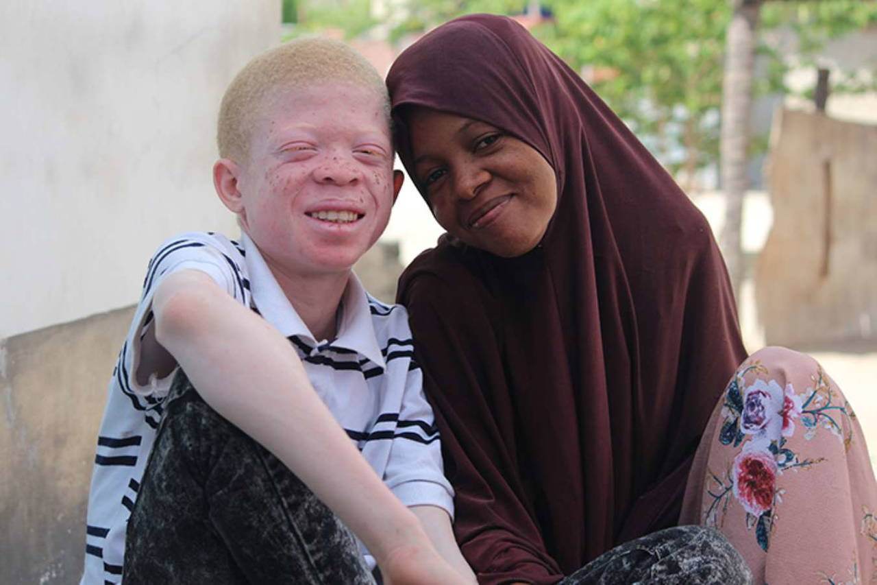 13 Haziran Dünya Albinizm Farkındalık Günü: Albinizm nedir? Albinizmin tedavisi var mı?