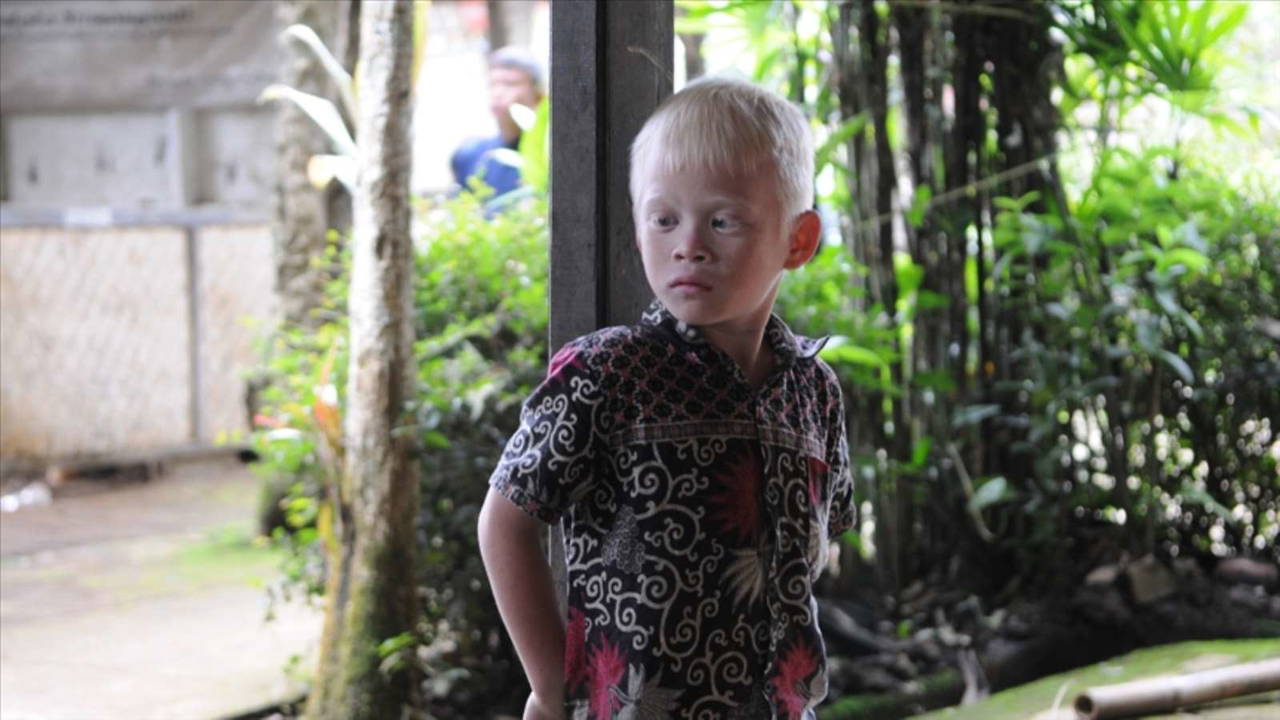 13 Haziran Dünya Albinizm Farkındalık Günü: Albinizm nedir? Albinizmin tedavisi var mı?