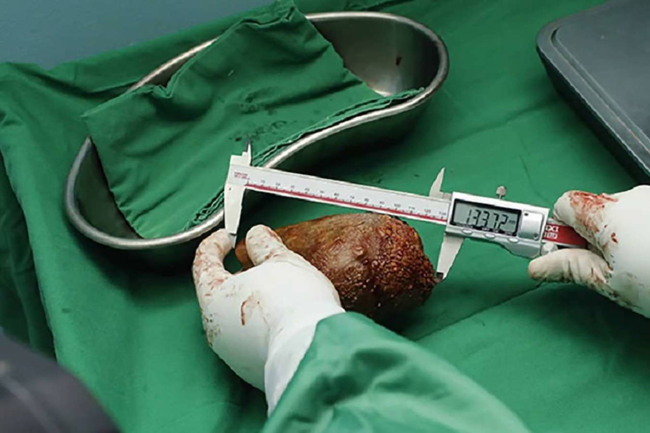 Sri Lanka’da dünya rekoru: 801 gram ağırlığında böbrek taşı çıkarıldı
