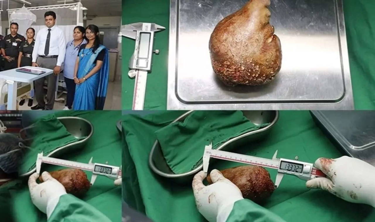 Sri Lanka’da dünya rekoru: 801 gram ağırlığında böbrek taşı çıkarıldı