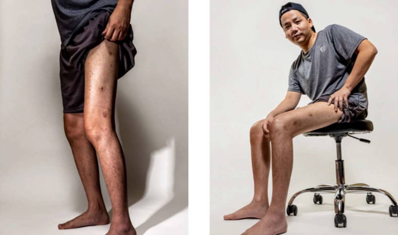 Boy uzatma ameliyatı olmak isteyenlerin dikkatine...