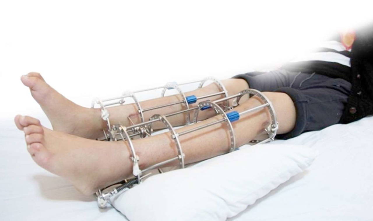 Boy uzatma ameliyatı olmak isteyenlerin dikkatine...