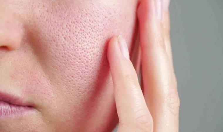 Evinizde kolayca uygulayarak pürüzsüz bir cilde sahip olun: Gözenekleri küçülten 5 doğal yöntem