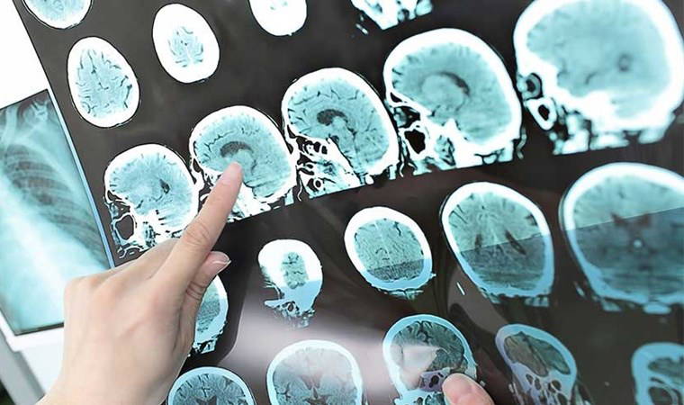 Hamilelerin dikkatine: Bu belirtiler 'beyin kanaması' işareti olabilir
