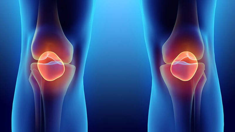 Uzmanı uyardı: Dizlerde ağrı 'kireçlenme' habercisi olabilir