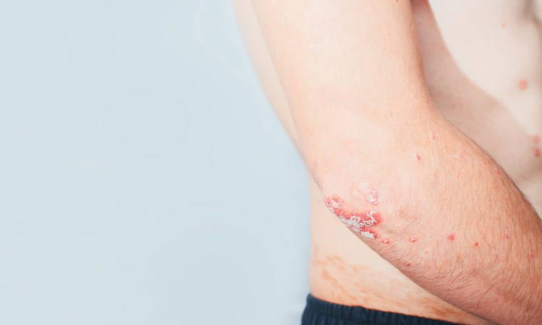 Baharda sık görülen 5 cilt hastalığı