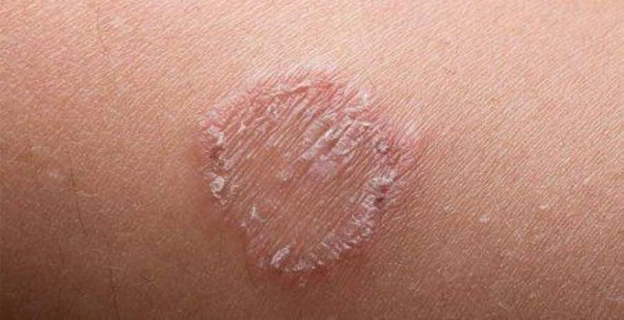 Baharda sık görülen 5 cilt hastalığı