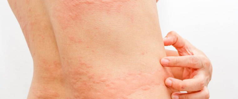 Baharda sık görülen 5 cilt hastalığı