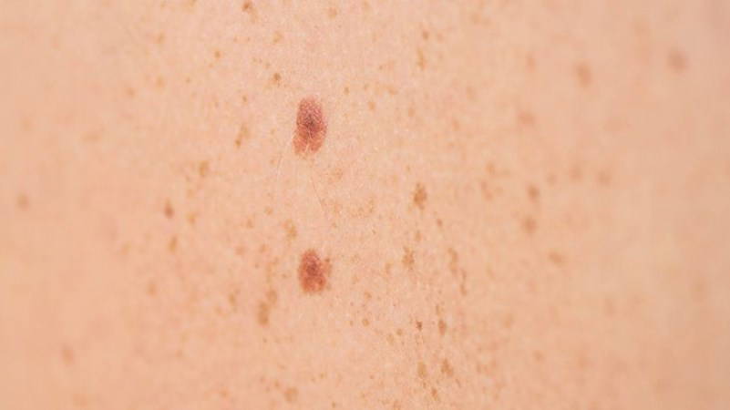 Baharda sık görülen 5 cilt hastalığı