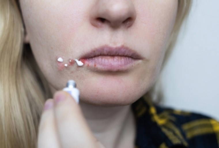 Doğadan gelen şifa ile ağrısız ve hızlı çözümler: Uçuğa iyi gelen 7 etkili doğal yöntem