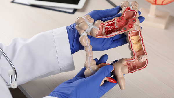 'Hemoroid' sanılıp geçiştiriliyor: Kolon kanserinde bu belirtilere dikkat